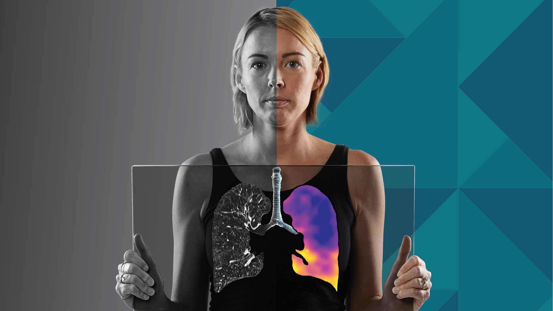 4DMedical CT:VQ - Ventilation and Perfusion Analysis - Maximum Contrast and No Injections