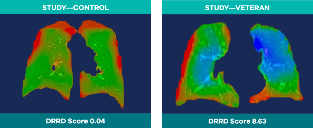 Lungs of study control patient and lungs of study veteran with biopsy confirmed Constrictive Bronchiolitis