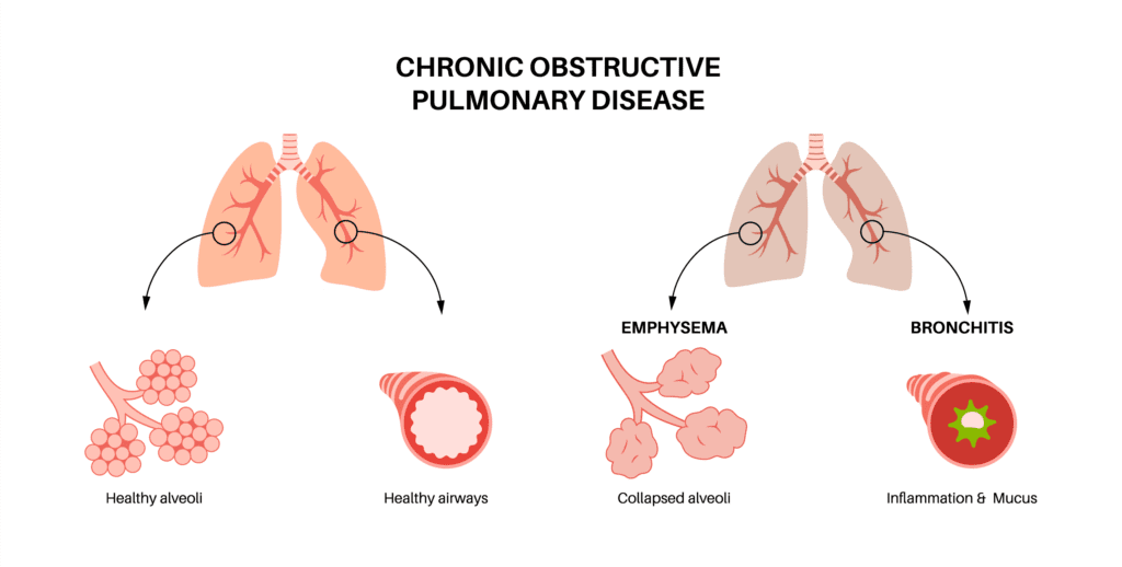 COPD - Healthy and Diseased Lungs