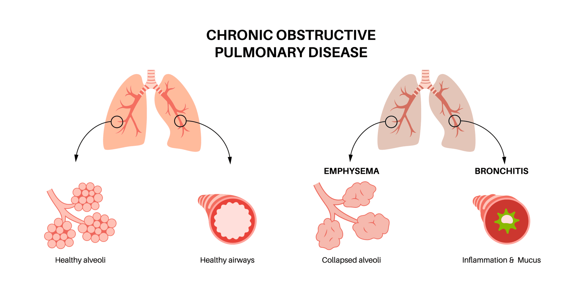 Chronic Obstructive Pulmonary Disease (COPD) and the Importance of Lung ...