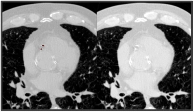 Rapid, fully-automated
AI analysis compatible with any non-contrast chest CT