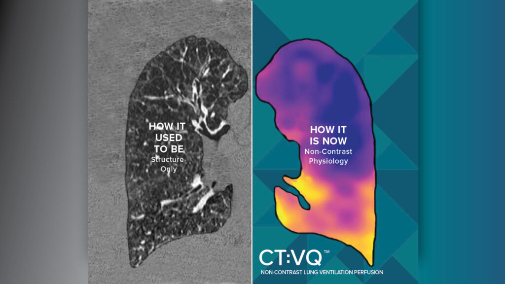 CT:VQ™ Non-Contrast Lung Ventilation Perfusion