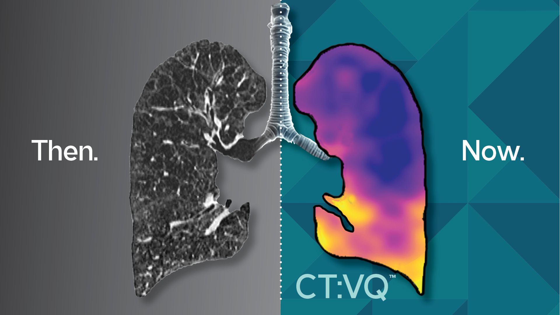 4DMedical CT:VQ - Then: Structural Only and Now: See the Physiology